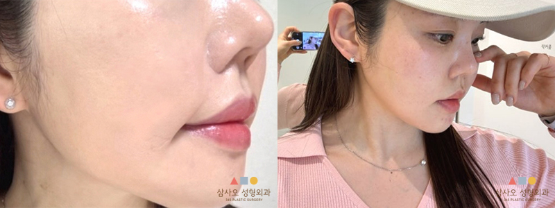 수술 후