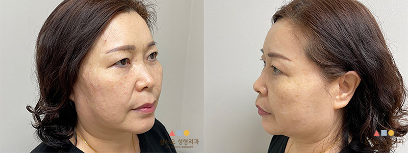수술 전