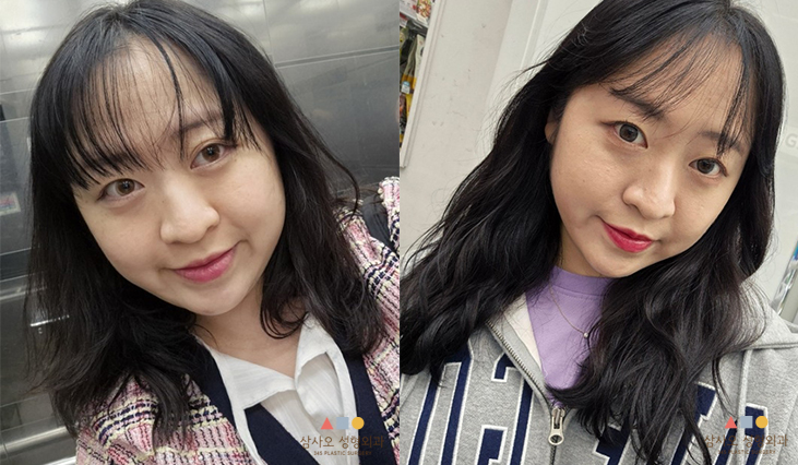 수술 전