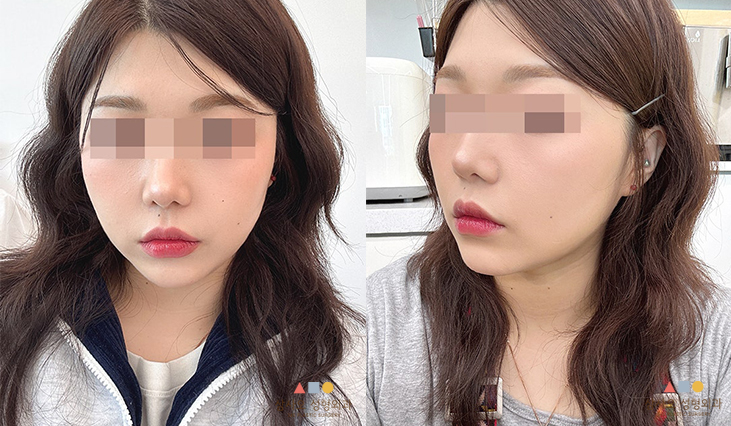 수술 후