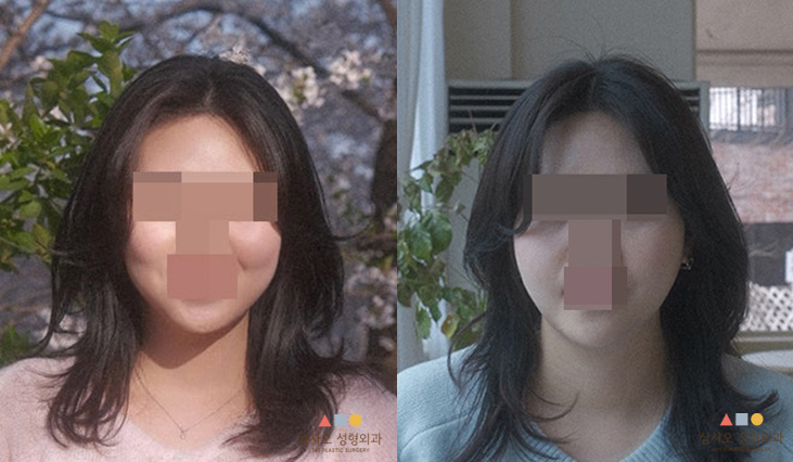 수술 후