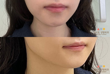 수술 전