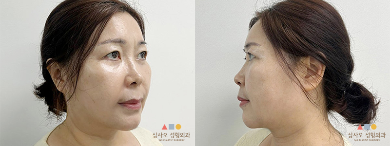 수술 후