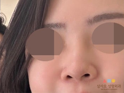 수술 전
