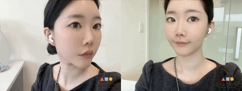 수술 전