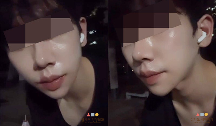 수술 후