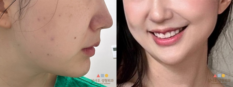 수술 후