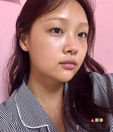 수술 후