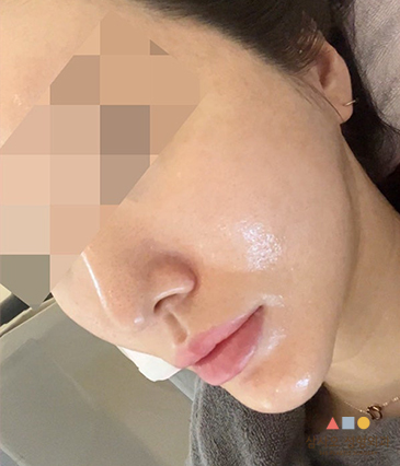 수술 후
