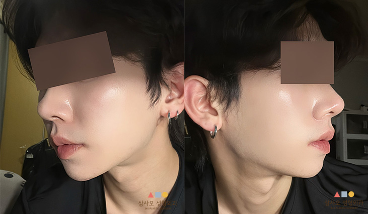 수술 후