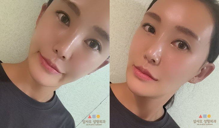 수술 후