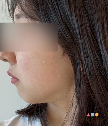 수술 전