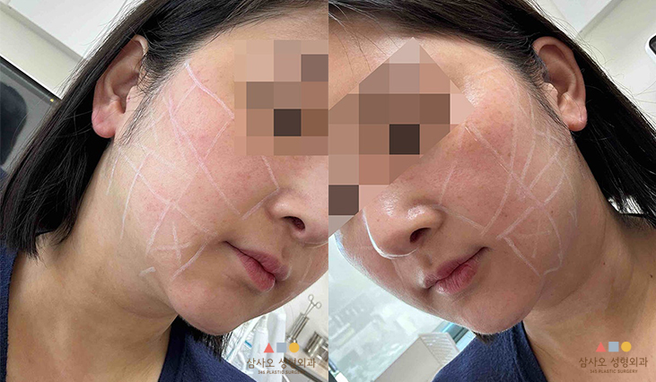 수술 전