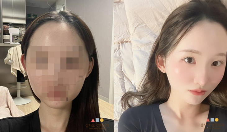 수술 후