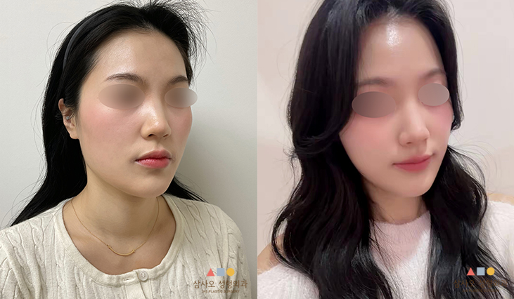 수술 후