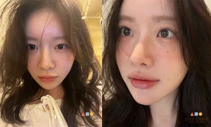 수술 후