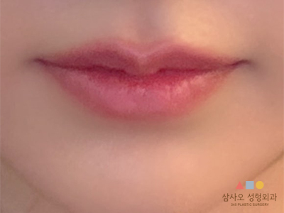 수술 전