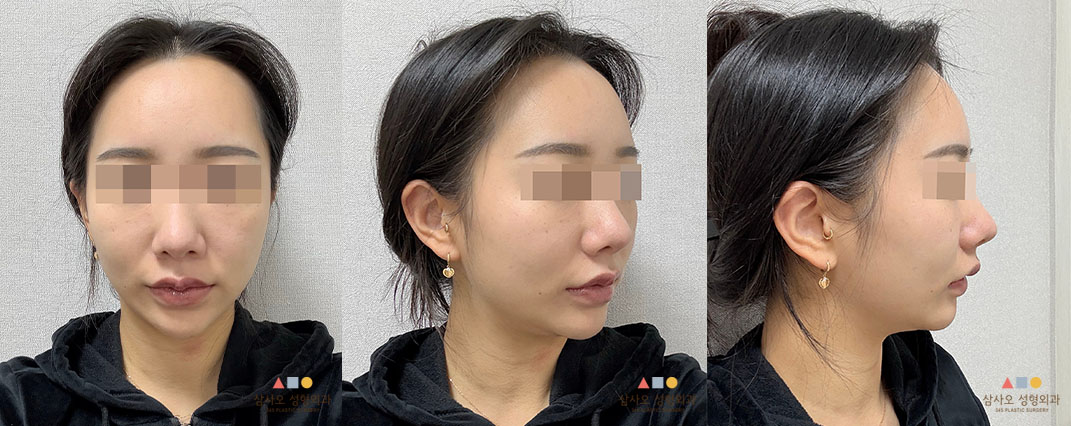 수술 전