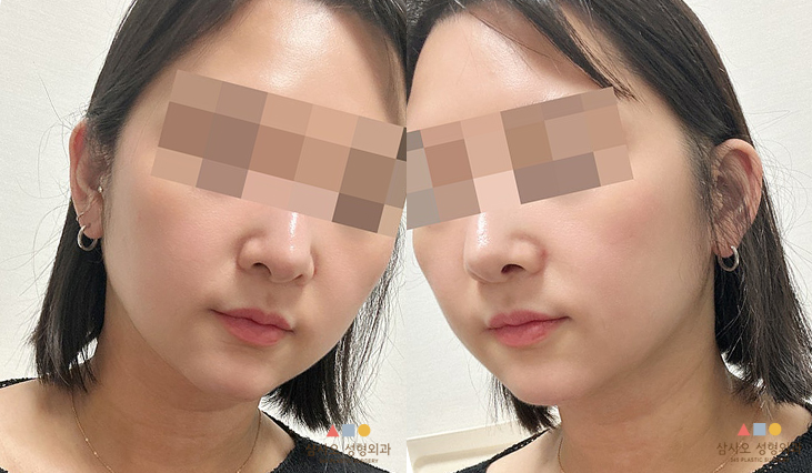 수술 후