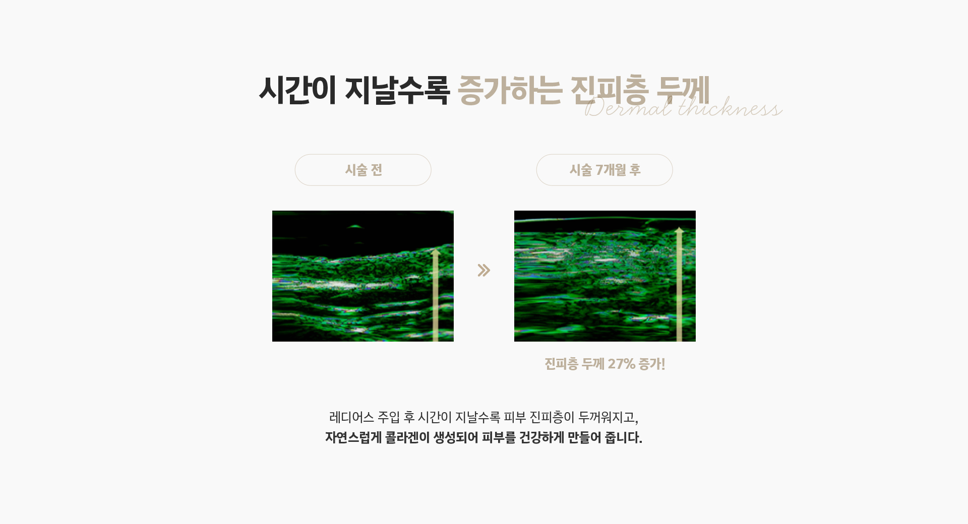 시간이 지날수록 증가하는 진피층 두께 - 레디어스 주입 후 진피층 두께 27% 증가, 콜라겐 생성으로 건강한 피부