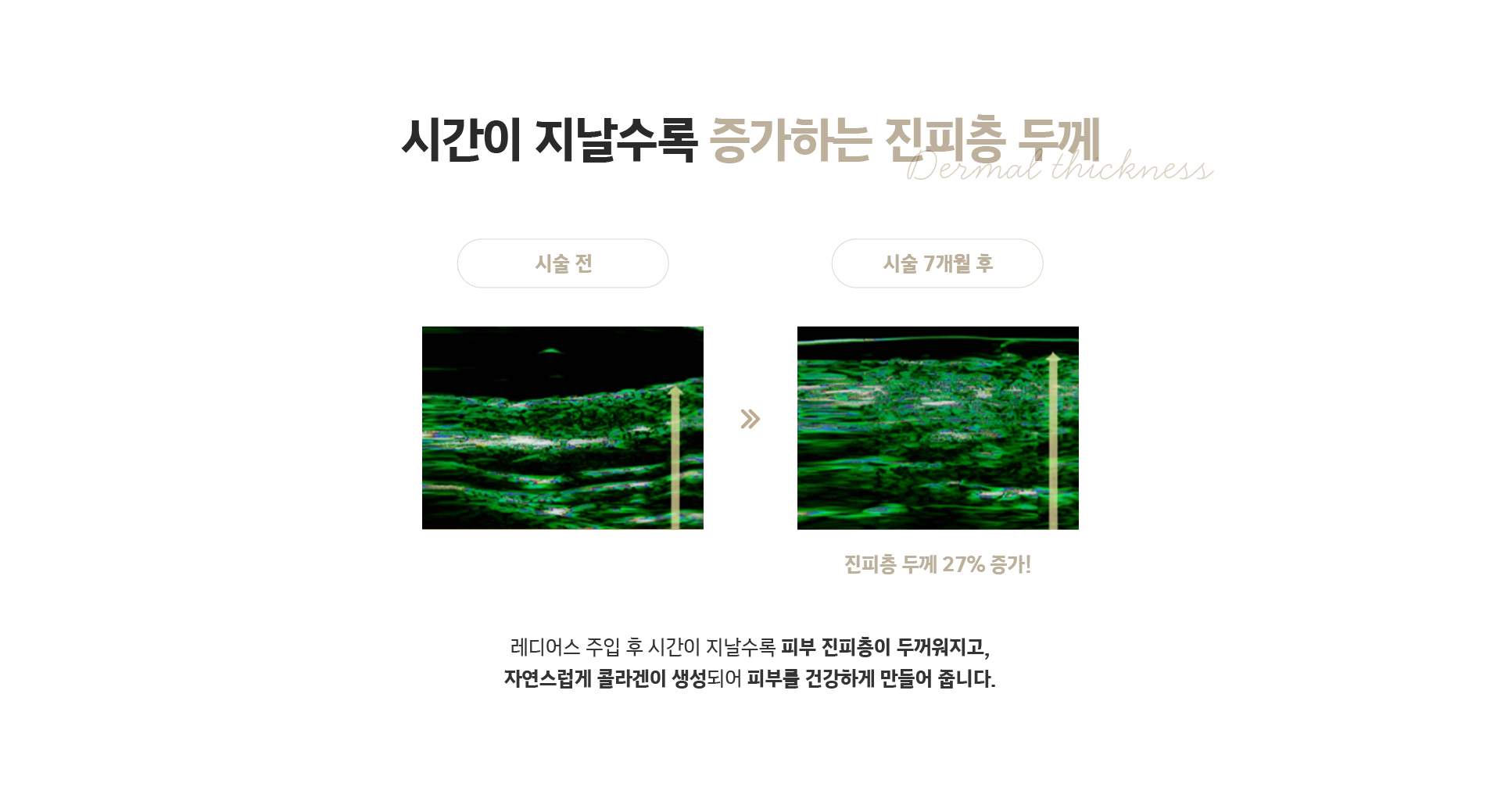 시간이 지날수록 증가하는 진피층 두께 - 레디어스 주입 후 진피층 두께 27% 증가, 콜라겐 생성으로 건강한 피부